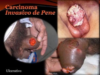 Carcinoma Invasivo de PeneUlcerativo