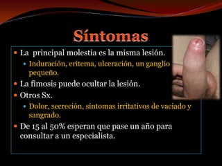 SíntomasLa  principal molestia es la misma lesión.Induración, eritema, ulceración, un ganglio pequeño.La fimosis puede ocultar la lesión.Otros Sx.Dolor, secreción, síntomas irritativos de vaciado y sangrado.De 15 al 50% esperan que pase un año para consultar a un especialista.