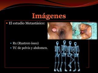 ImágenesEl estudio Metastásico:Rx (Rastre0 óseo)TC de pelvis y abdomen.
