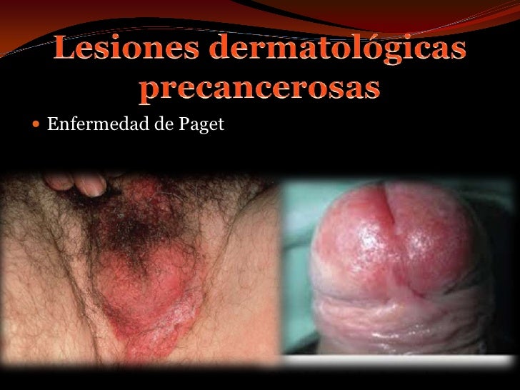 En neerogirovannom el estado el miembro pequeño