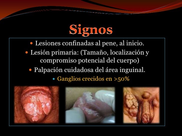 Me Sale Pus Del Pene Cáncer de Pene