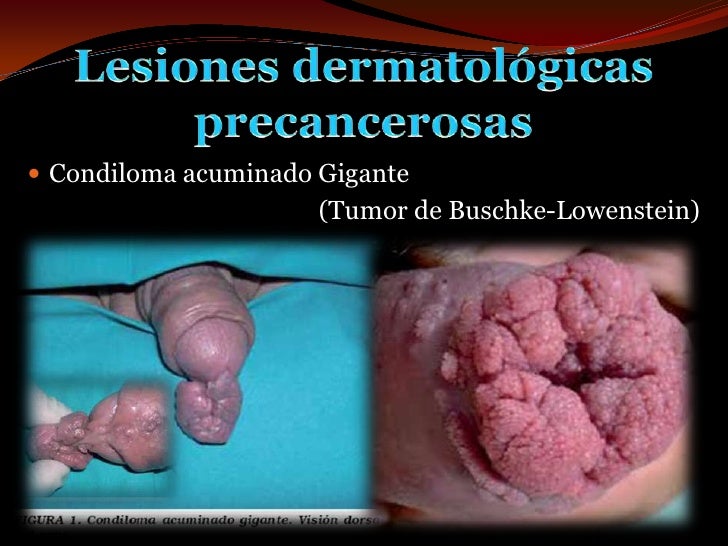 Encontrar el medio para el aumento del miembro