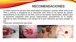 La mejor manera de prevenir esta enfermedad es empezar a enseñar desde ahora a los
niños y jóvenes a protegerse de la exposición solar tanto en las épocas de estudio,
especialmente en las clases al aire libre, como en las épocas vacacionales, debido a que
la exposición exagerada tiene graves repercusiones, generalmente en la adultez.
Además se debe concientizar a los adultos de la gran relevancia que tiene proteger su
piel.
Todos esto, precisamente para evitar:
RECOMENDACIONESRECOMENDACIONES
6 7 8 9
 