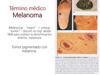 Término médico
Melanoma
Melan(o) gr. “negro” + oma gr.
“tumor”: docum. en ingl. desde
1838 para sustituir la denominación
anterior, melanosis.
Tumor pigmentado con
melanina.
 