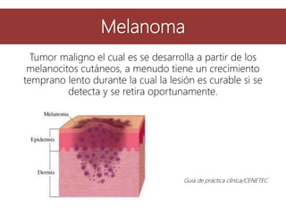 Melanoma
Tumor maligno el cual es se desarrolla a partir de los
melanocitos cutáneos, a menudo tiene un crecimiento
temprano lento durante la cual la lesión es curable si se
detecta y se retira oportunamente.
Guía de práctica clínica/CENETEC.
 