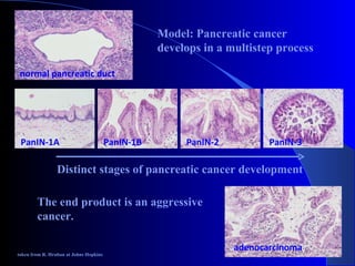 normal pancreatic duct adenocarcinoma Model: Pancreatic cancer develops in a multistep process The end product is an aggressive  cancer. taken from R. Hruban at Johns Hopkins Distinct stages of pancreatic cancer development PanIN-1A PanIN-1B PanIN-2 PanIN-3 