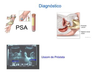 Diagnóstico
Ussom de Próstata
 