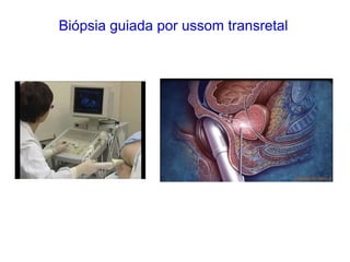 Biópsia guiada por ussom transretal
 