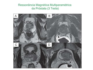 Ressonância Magnética Multiparamétrica
da Próstata (3 Tesla)
 