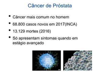 Câncer de Próstata
• Câncer mais comum no homem
• 68.800 casos novos em 2017(INCA)
• 13.129 mortes (2016)
• Só apresentam sintomas quando em
estágio avançado
 
