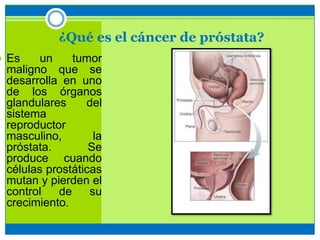 ¿Qué es el cáncer de próstata?
 Es un tumor
maligno que se
desarrolla en uno
de los órganos
glandulares del
sistema
reproductor
masculino, la
próstata. Se
produce cuando
células prostáticas
mutan y pierden el
control de su
crecimiento.
 