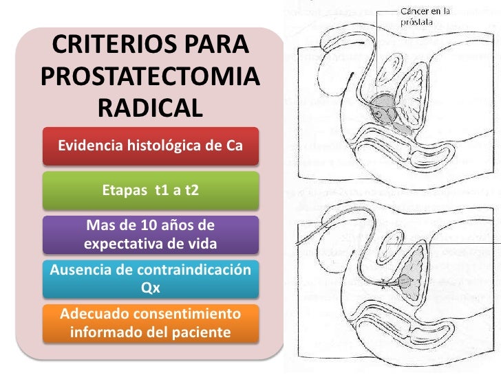 Cancer De Prostata Novembro Azul Ppt Cancer De Prostata