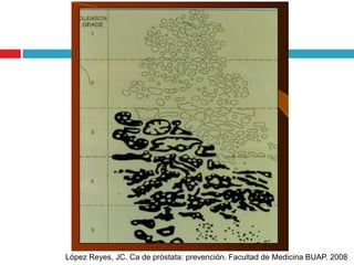 López Reyes, JC. Ca de próstata: prevención. Facultad de Medicina BUAP. 2008
 