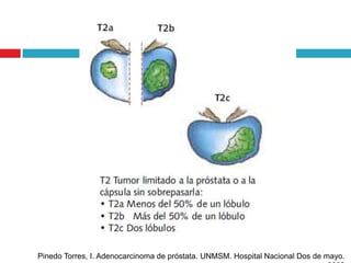 Pinedo Torres, I. Adenocarcinoma de próstata. UNMSM. Hospital Nacional Dos de mayo.
 
