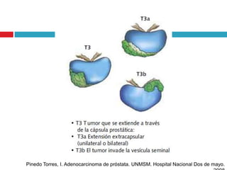 Pinedo Torres, I. Adenocarcinoma de próstata. UNMSM. Hospital Nacional Dos de mayo.
 