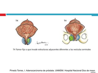 Pinedo Torres, I. Adenocarcinoma de próstata. UNMSM. Hospital Nacional Dos de mayo.
 