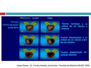López Reyes, JC. Ca de próstata: prevención. Facultad de Medicina BUAP. 2008
 