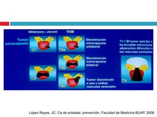 López Reyes, JC. Ca de próstata: prevención. Facultad de Medicina BUAP. 2008
 