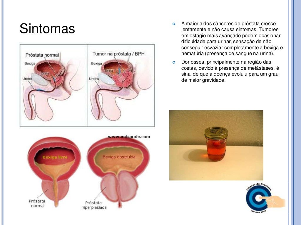 Testimonios De Operados De Prostata Câncer de próstata