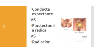 Tx
Conducta
expectante
VS
Porstectomí
a radical
VS
Radiación
 