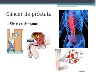 Câncer de próstata 
• Sinais e sintomas 
 