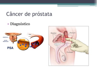 Câncer de próstata 
• Diagnóstico 
 