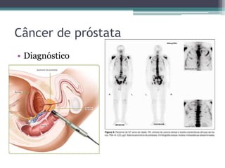 Câncer de próstata 
• Diagnóstico 
 