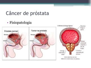 Câncer de próstata 
• Fisiopatologia 
 