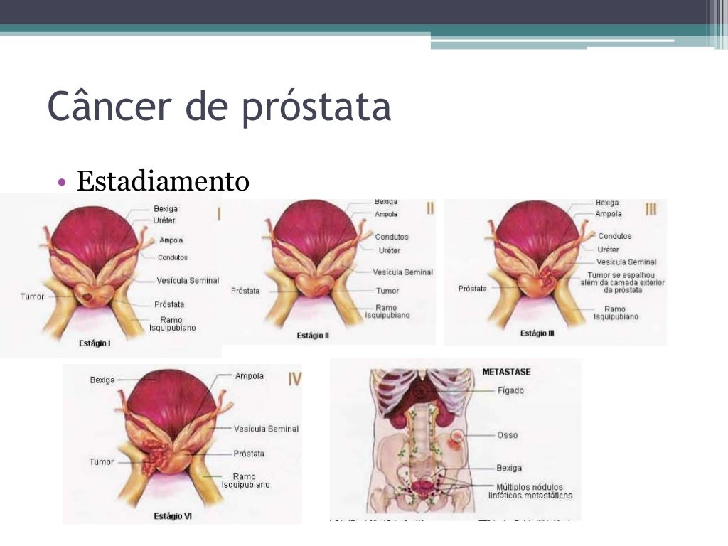 Câncer de próstata