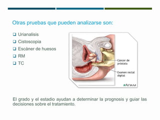 Otras pruebas que pueden analizarse son: 
 Urianalisis 
 Cistoscopia 
 Escáner de huesos 
 RM 
 TC 
El grado y el estadio ayudan a determinar la prognosis y guiar las 
decisiones sobre el tratamiento. 
 