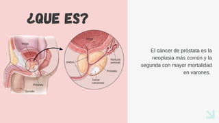 ¿Que es?
El cáncer de próstata es la
neoplasia más común y la
segunda con mayor mortalidad
en varones.
 