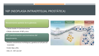 NIP (NEOPLASIA INTRAEPITELIAL PROSTÁTICA)
Revestimiento epitelial de la glándula:
• Células basales  Carcinoma acinar
• Células columnares  NIP y otros.
NIP: transformación carcinomatosa del
revestimiento.
• Muestra características morfológicas y genéticas al CaP pero sin
invasividad.
• Grado: Bajo y Alto.
• Alto: 25 – 80 % de CaP.
 