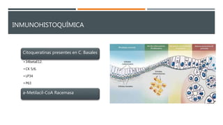INMUNOHISTOQUÍMICA
Citoqueratinas presentes en C. Basales
• 34betaE12.
• CK 5/6.
• LP34
• P63
a-Metilacil-CoA Racemasa
 