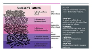 PATRÓN 1.
Nódulos compactos, uniforme,
acinos de tamaño mediano.
PATRÓN 2.
Se añade en el borde del
nódulo mínima infiltración. Mas
estroma entre células.
PATRÓN 3.
Glándulas más pequeñas que
los observados en el 1. Infiltra
hacia ácinos prostáticos no
neoplásicos.
PATRON 4.
Glándulas microacinares
fusionadas.
PATRÓN 5.
No hay diferenciación, placas o
cordones.
 
