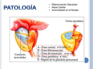  70%
15-20%
10-15%
• Diferenciación Glandular
• Atipia Celular
• Anormalidad en el Núcleo
 