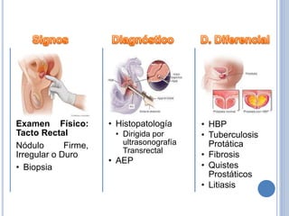 Examen Físico:
Tacto Rectal
Nódulo Firme,
Irregular o Duro
• Biopsia
• Histopatología
• Dirigida por
ultrasonografía
Transrectal
• AEP
• HBP
• Tuberculosis
Protática
• Fibrosis
• Quistes
Prostáticos
• Litiasis
 