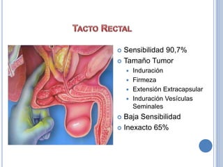  Sensibilidad 90,7%
 Tamaño Tumor
 Induración
 Firmeza
 Extensión Extracapsular
 Induración Vesículas
Seminales
 Baja Sensibilidad
 Inexacto 65%
 