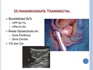  Sensibilidad 92%
 VPP 92,7%
 VPN 91,6%
 Áreas hipoecoicas en:
 Zona Periférica
 Zona Central
 1/3 son Ca
 