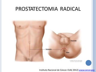 PROSTATECTOMIA RADICAL
Instituto Nacional de Cáncer. EUA( 2012) www.cancer.gov
 