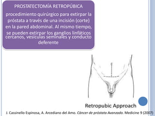 PROSTATECTOMÍA RETROPÚBICA
procedimiento quirúrgico para extirpar la
próstata a través de una incisión (corte)
en la pared abdominal. Al mismo tiempo,
se pueden extirpar los ganglios linfáticos
cercanos, vesículas seminales
deferente
y conducto
J. Cassinello Espinosa, A. Arcediano del Amo. Cáncer de próstata Avanzado. Medicine 9 (2007)
 