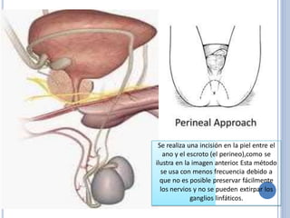 Se realiza una incisión en la piel entre el
ano y el escroto (el perineo),como se
ilustra en la imagen anterior. Esta método
se usa con menos frecuencia debido a
que no es posible preservar fácilmente
los nervios y no se pueden extirpar los
ganglios linfáticos.
 