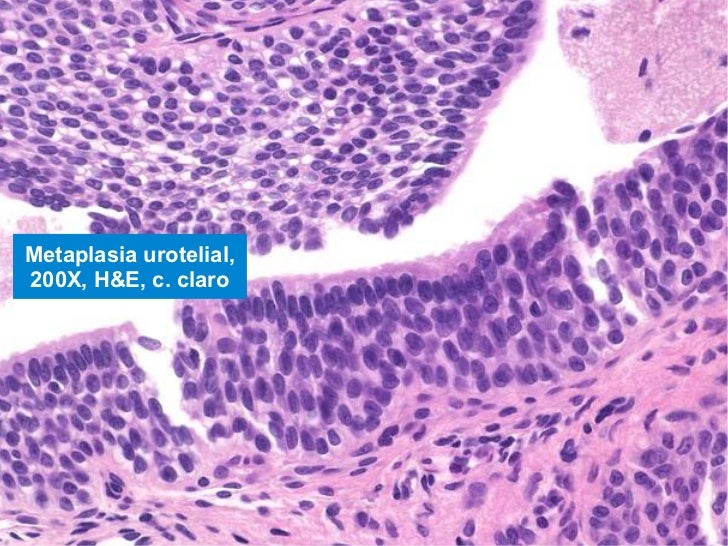 Resultados de la biopsia de próstata inesperados: PIN y ASAP