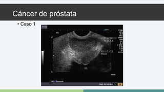 Cáncer de próstata 
• Caso 1 
 