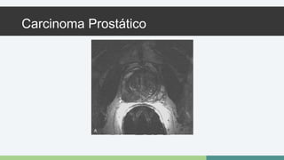 Carcinoma Prostático 
 