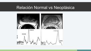 Relación Normal vs Neoplásica 
 