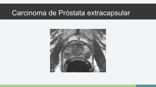 Carcinoma de Próstata extracapsular 
 