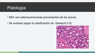 Patología 
• 95% son adenocarcinomas provenientes de los acinos 
• Se evalúan según la clasificación de Gleason(1-5) 
 