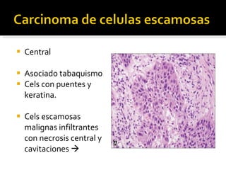 Central Asociado tabaquismo Cels con puentes y keratina. Cels escamosas malignas infiltrantes con necrosis central y cavitaciones   