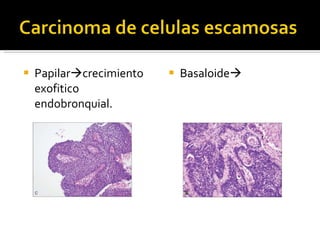 Papilar  crecimiento exofitico endobronquial. Basaloide  