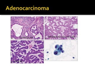 GLANDULAR BRONQUIOLOALVEOLAR PAPILAR 
